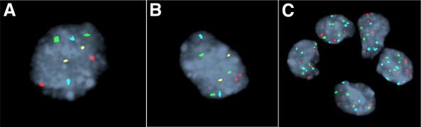 A: disomi (normal) B: trisomi 7 C: polysomi