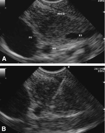 Diagnose CT + Børstecyt Miniendoskopi