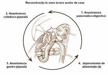 alimentație sau se trece o sondă naso-gastrică prin anastomoza gastro-jejunală Anastomoza pancreatico-jejunală Anastomoza pancreatico-jejunală tehnica prin invaginare capul pancreasului