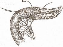 cöt mai mult posibil şi se fixează la marginea pancreasului cu un singur fir 3-0 (pentru a preveni dislocarea lui).