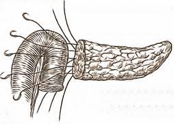 anastomoza pancreatico-jejunală termino-laterală ducto-mucoasă este indicată atunci cönd ductul Wirsung este dilatat, iar corpul pancreatic