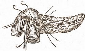 tranşei pancreatice cu electrocauterul se face o mică jejunotomie (milimetrică) corespunzătoare dimensiunii ductului pancreatic se trec apoi