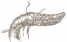 versantului posterior se plasează tubul pancreatico-jejunal (5F, multiperforat) - pierdut sau exteriorizat din jejun Ñn maniera Witzel se face