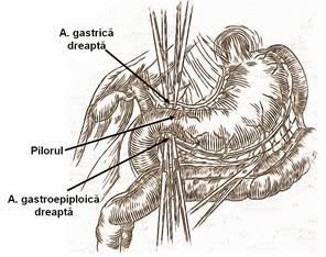 Continuitatea tubului digestiv se restabileşte (după rezecţie) printr-o anastomoză duodenojejujanlă termino-laterală Ligatura arterei gastrice drepte şi a arterei gastroepiploice drepte ligatura
