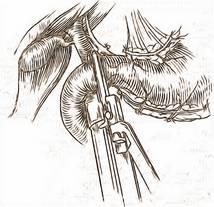 pilorice incizia ligamentului gastro-colic (la deschiderea pe această cale a bursei omentale) trebuie facută Ñn afara vaselor gastro-epiploice drepte care trebuie păstrate Secţionarea duodenului