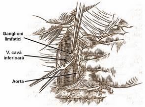 Limfadenectomia pericavă şi periaortică Ñndepărtarea ţesutului moale situat anterior de VCI se continuă cu extirparea ţesutului moale din şanţul interaortico-cav (care rămane pe capul pancreatic)