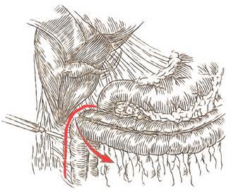 baza mezocolonului transvers trece peste capul pancreasului uneori cancerul de cap