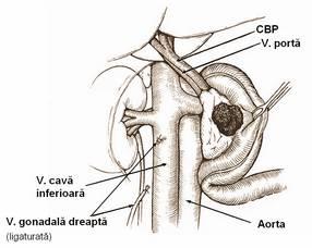 la nivelul la care vena renală stöngă Ñncrucișează aorta; cönd tumora invadează faţa