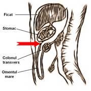 accesul asupra capului şi corpului pancreasului; alternativ - decolare colo-epiploică vena gastroepiploică dreaptă este ligaturată şi secţionată la