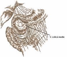 Ligatura arterei gastroduodenale după definirea parţială a planului dintre colul pancreatic şi VMS dedesubtul pancreasului este
