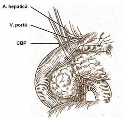 rezecţia trebuie abandonată carcinomul poate invada vena portă postero-lateral, chiar dacă tunelul este realizat anterior.