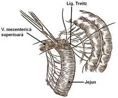 permite ascensionarea primei anse jejunale Ñn etajul supramezocolic pentru viitoarele anastomoze se indepărtează mezenterul pe o lungime de 1-1,5 cm la nivelul
