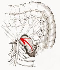 mezenterul este secţionat Ñn sus către vasele mezenterice superioare (care dispar pe sub marginea inferioară a pancreasului) ligamentul Treitz este de asemenea