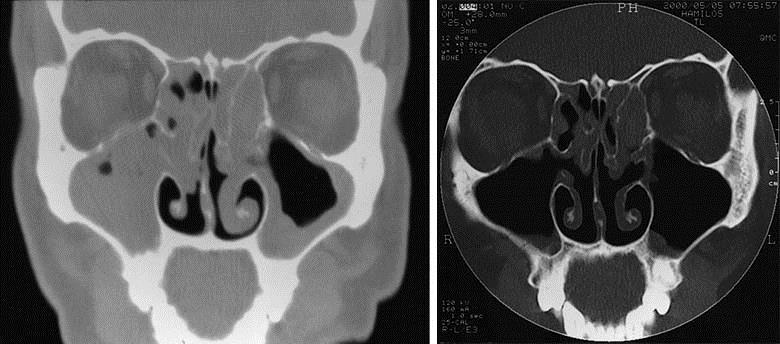 Kronisk bihulebetennelse CT bihuler Ct funn- obligatorisk for diagnosen