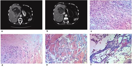 Tabell 3 Status ved oppstart og etter seks måneders behandling med imatinibmesylat Måneder etter primær diagnose Tidligere tilbakefallsbehandling Symptomer ved oppstart Sykdomslokalisasjon