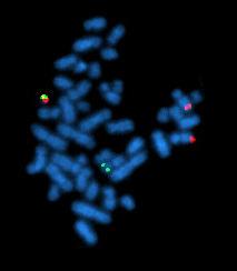 001 %) Påvisning av mutasjoner i BCR-ABL1 Sanger sekvensering (sensitivitet 15-20 %) NGS (sensitivitet 1-2