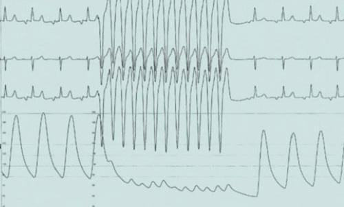 Figur 3 EKG og aortatrykk ved hurtig pacing med temporær pacemaker