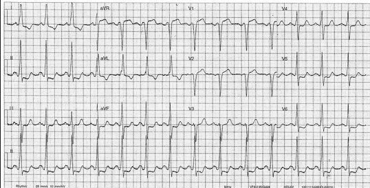 Se etter: EKG