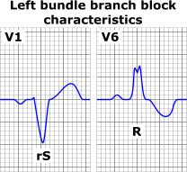 Normal QRS LBBB