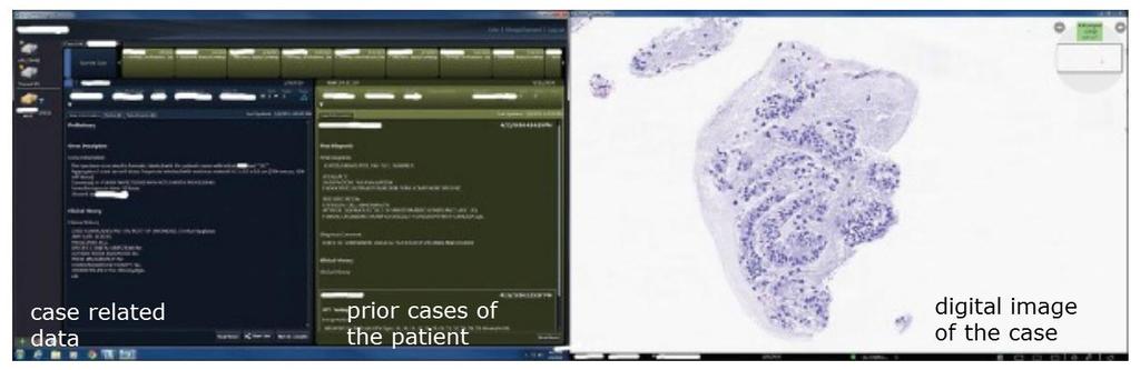3.7.1 Pittsburgh Patologene bruker 2 skjermer; biopsi relaterte data er vist på venstre skjerm, det digitale snitt vist på høyre side med Omnyx vieweren (4): Figur 5: Patologens