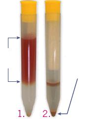 BD SurePath væskebasert Pap test Cellesuspensjonen i prøvebeholder vortekses for å løsne cellene fra børstehodet trapped debris is removed enriched cell pellet Sentrifugal sedimentering i ulike