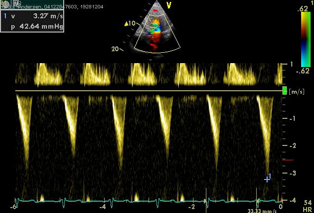 LVOT