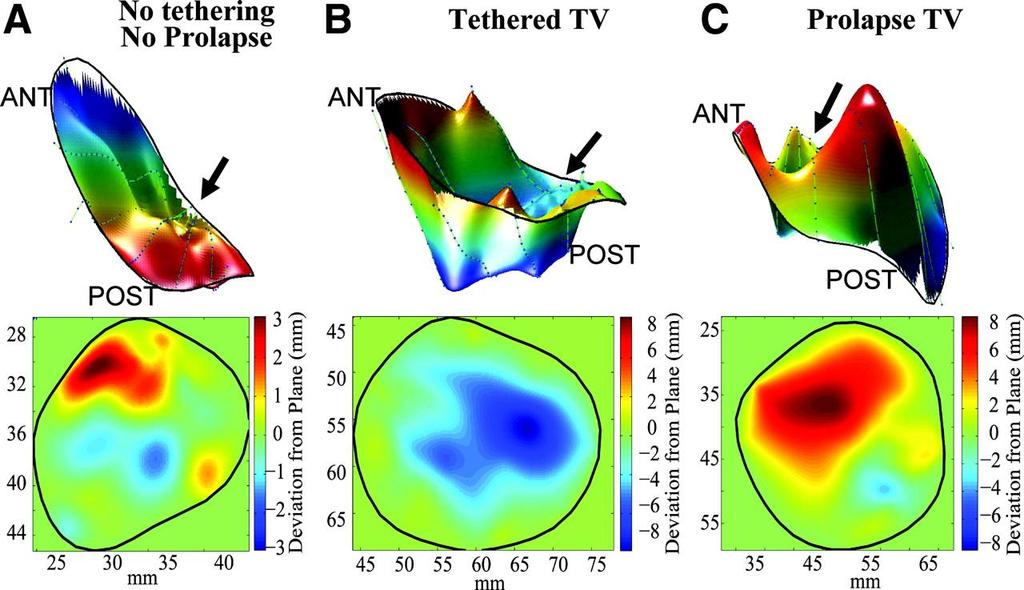 HVHS-Trikuspidalklaffelekkasje mekanismer Takahashi K et al.