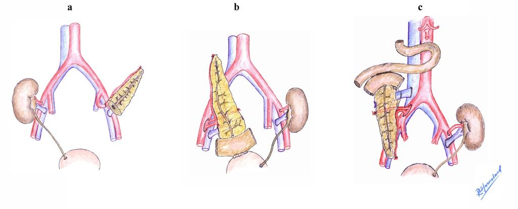 Figur 1. Operasjonsteknikker for pankreastransplantasjon i 3 ulike æraer (a-c/æra 1-3). Illustrert av Rune Horneland.