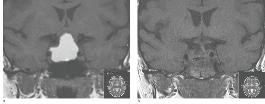 Den større cystiske komponenten ses med høyt signal og tangerer a. carotis interna bilateralt. b) Postoperativ status. Tumor er fjernet transsfenoidalt.