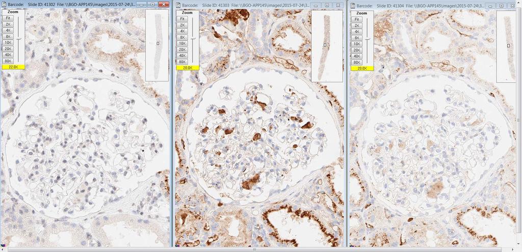 3 Amyloid A kappa lambda Det er lett å sammenligne