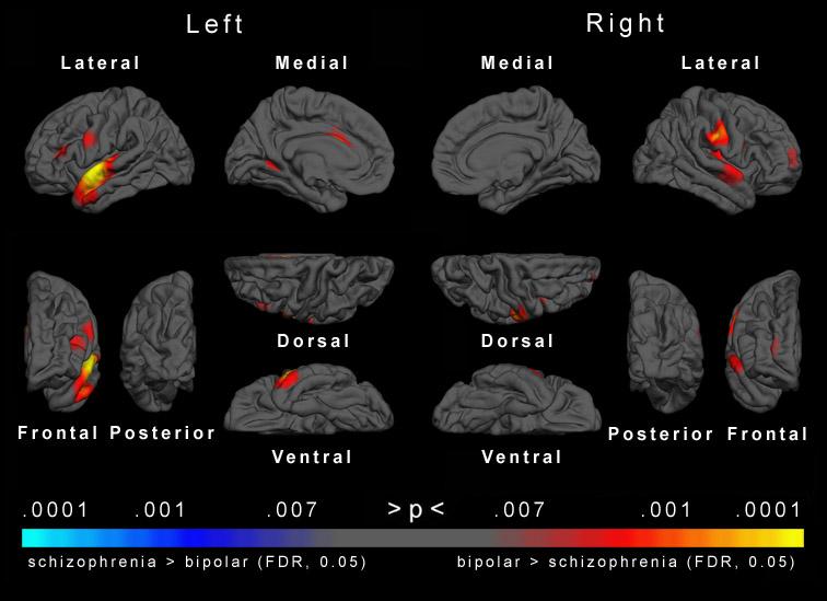 Bipolar lidelse: mindre kortikal tykkelse