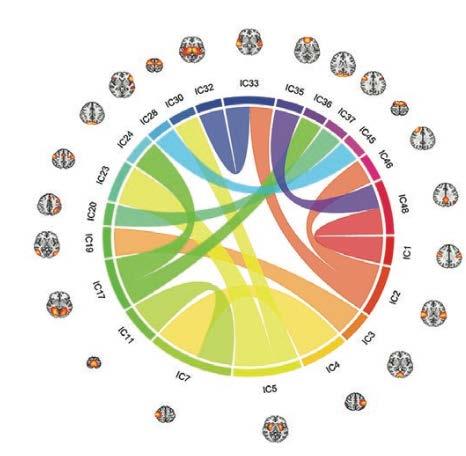 Schizofreni: konnektivitets lidelse? Robust reductions in functional connectivity in SCZ spectrum disorders, indicating disrupted information flow in sensory, subcortical, and frontal brain regions.