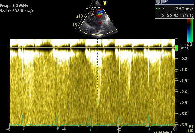 MS - Trp Hvile: 25 mmhg Maks