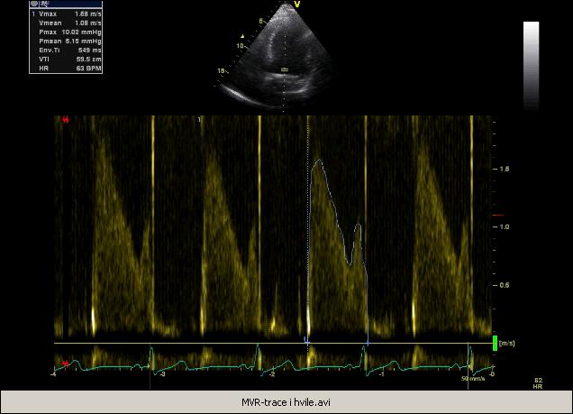 10/5 mmhg Maksimal