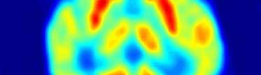 full body 18 F FDG PET scan of human brain