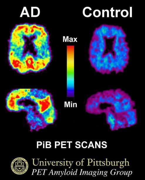 Amyloid PET Positronemitterende radionukleotider: [11C]Pittsburgh compound B [18F] ligander florbetapir flutemetamol