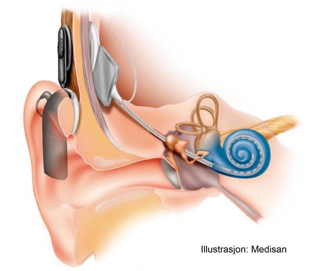 Bilde 1 Illustrasjon av cochleaimplantat Kilde: http://www.hlf.no/horselhemminger/cochlea-implantat/ 2.3.