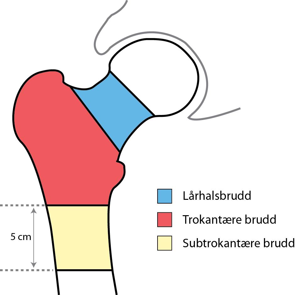 1.4 Hva er et hoftebrudd? Betegnelsen hoftebrudd brukes om brudd i den øvre enden av lårbeinet og defineres som ethvert brudd mellom leddbrusken og ned til 5 cm under trokanter minor [16].