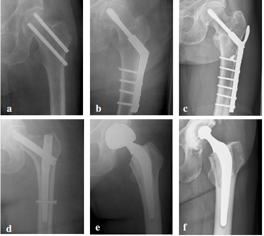 Figur 5 [55]. Røntgenbildene viser forskjellige type implantater: a. Osteosyntese med to skruer b. Osteosyntese med glideskrue c. Osteosyntese med glideskrue og trokantær støtteplate d.