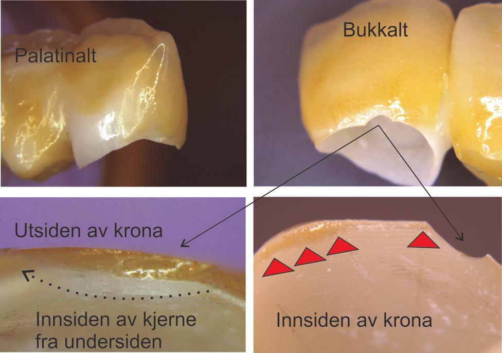 324-329-Vit art Reisegg Zirkonia som dentalt keram.