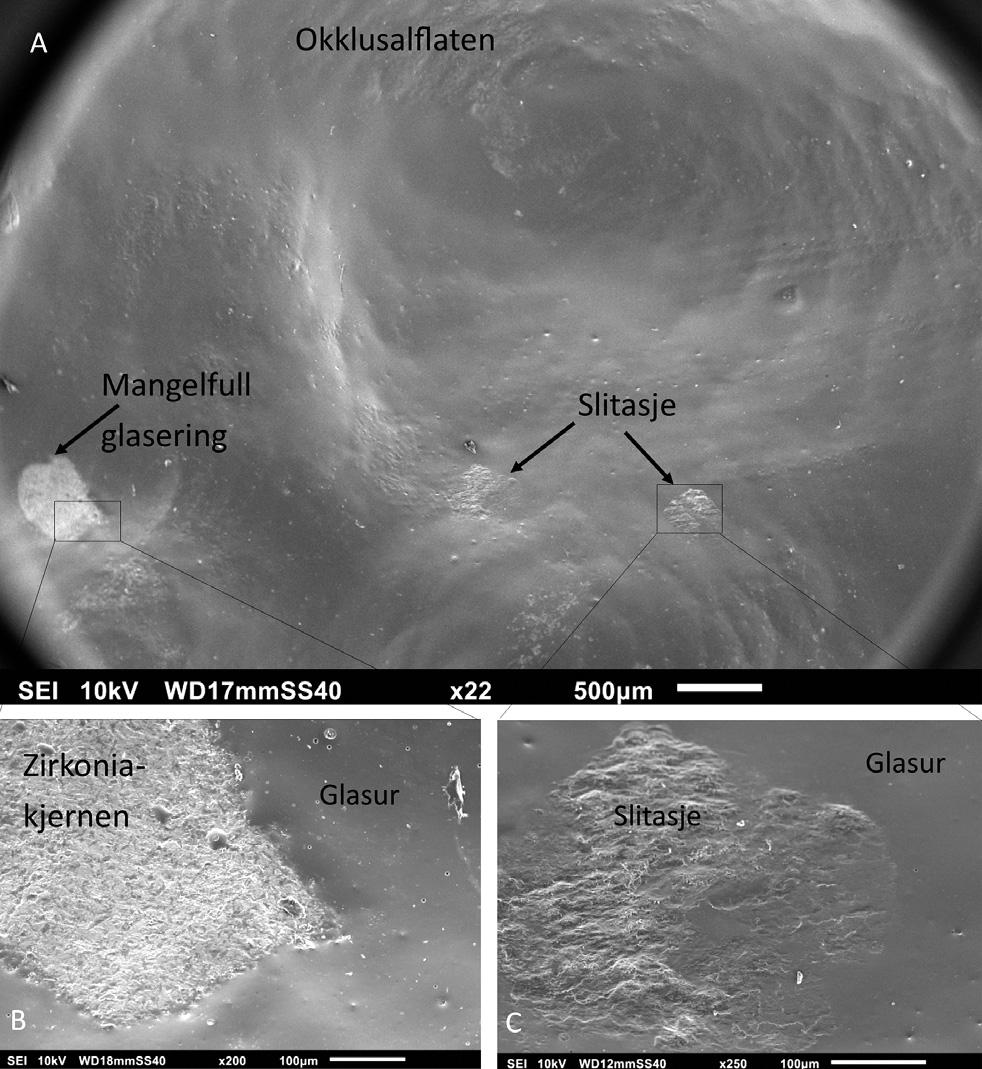 324-329-Vit art Reisegg Zirkonia som dentalt keram.fm Page 327 Tuesday, March 28, 2017 4:53 PM Figur 7. Døme på ei glasert zirkoniakrone som er slitt i ein tyggesimulator med 30 000 tygg på 250N.