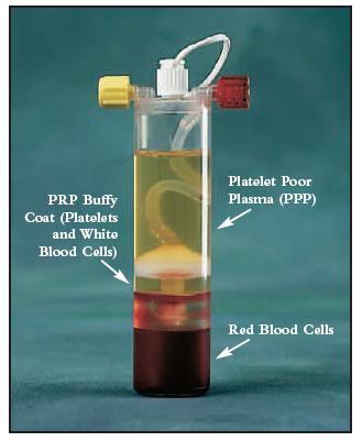 Platederiverte preparasjoner (PRP) Blood spinning - Pasientens eget blod brukes - Lager PRP - Injiserer