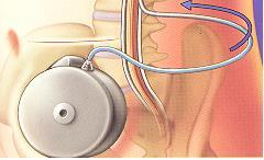 Intrathecal baklofen (ITB)