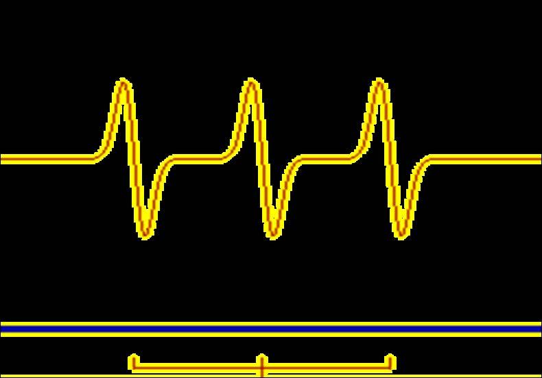 Dersom I = 1 kan m I ha tre mulig verdier, m I = 1, 0, -1 Dette gir tre mulige EPR