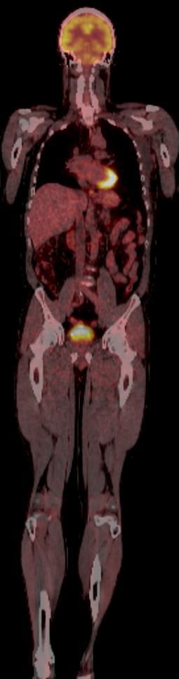 Bilde 5a Bilde 5b Bilde 5: Fordeling av 18F-FDG i kroppen a.