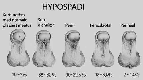 12.13 Hypospadi C Klingenberg Bakgrunn/klinikk Insidens: 1-3: 1000 levende fødte gutter.