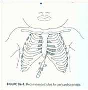 3.9 Pericardiocentese Bakgrunn Hjertetamponade sekundært til en alvorlig perikard-effusjon er en meget sjelden, men svært alvorlig komplikasjon til sentrale kateter hos nyfødte.