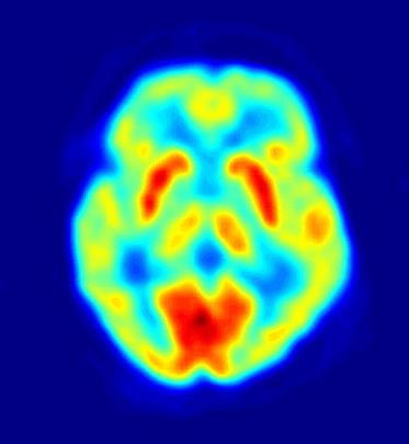 PET-BILDER Maximum intensity projection of