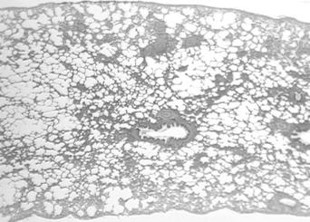 alveoli-s Hypersensi-vity-