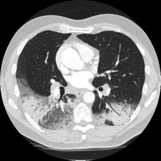 annen inters--ell lungesykdom (IPF) Hamman- Rich syndrom Kryptogen